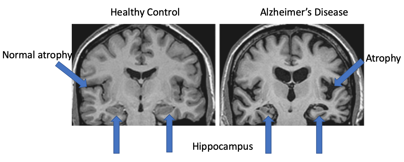 MRI Scan Of Brain – Alzheimer’s Disease – Dementia Services Information ...